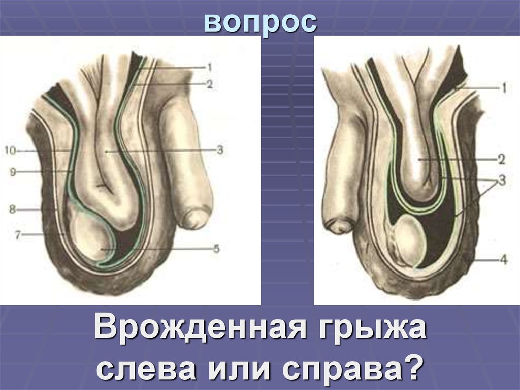 Паховая Грыжа Симптомы Фото