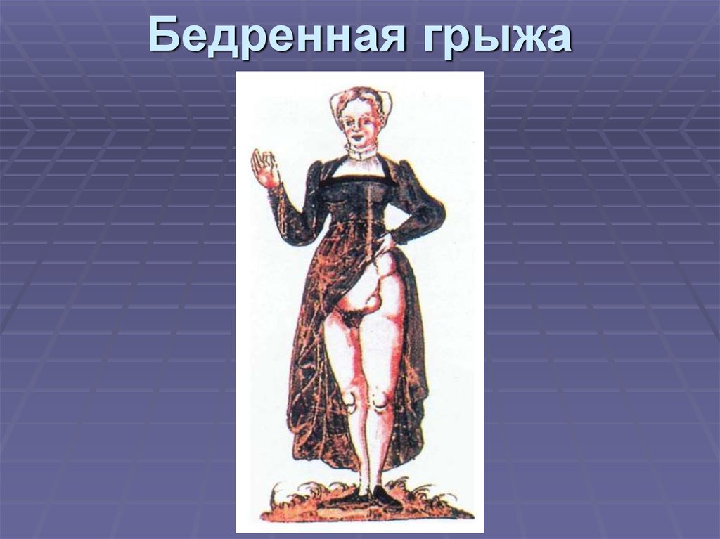 бедренная грыжа у женщин. содержимое бедренной грыжи. грыжи живота бедренные паховые. грыжевые ворота бедренной грыжи. место выхода бедренной грыжи.