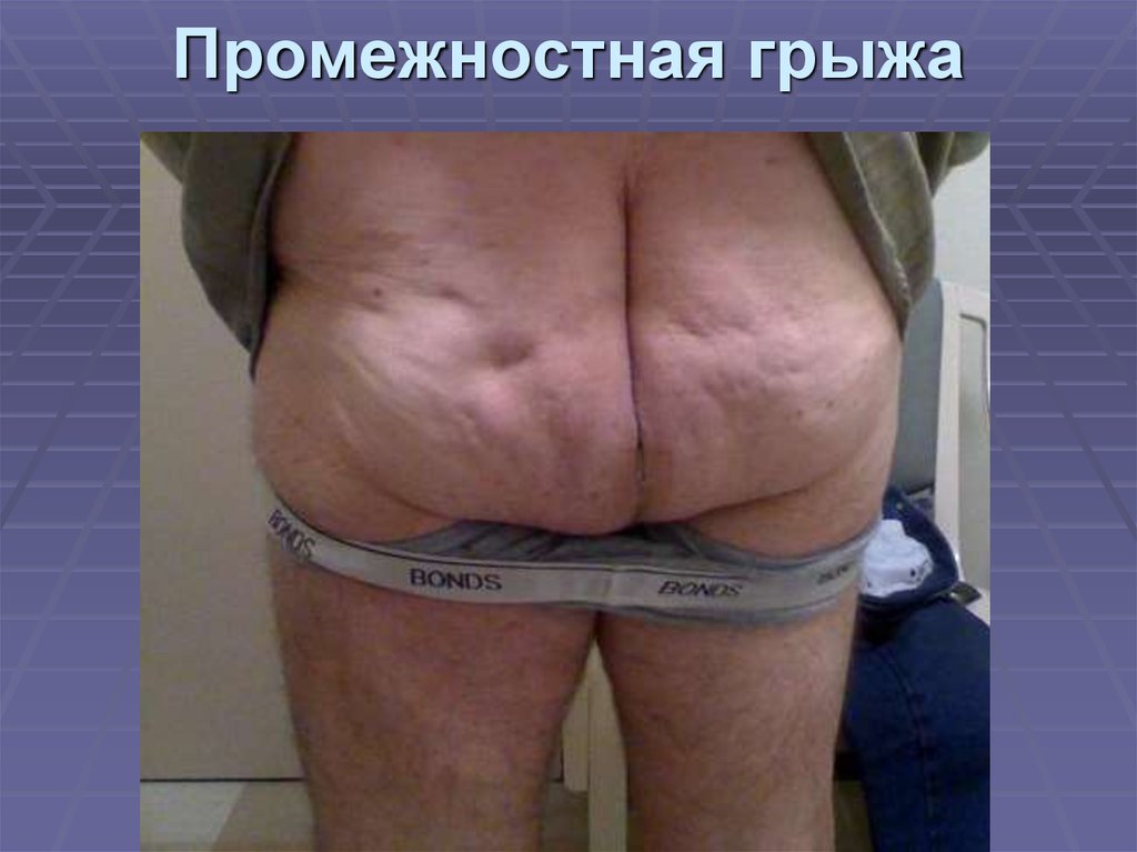 Промежностная грыжа