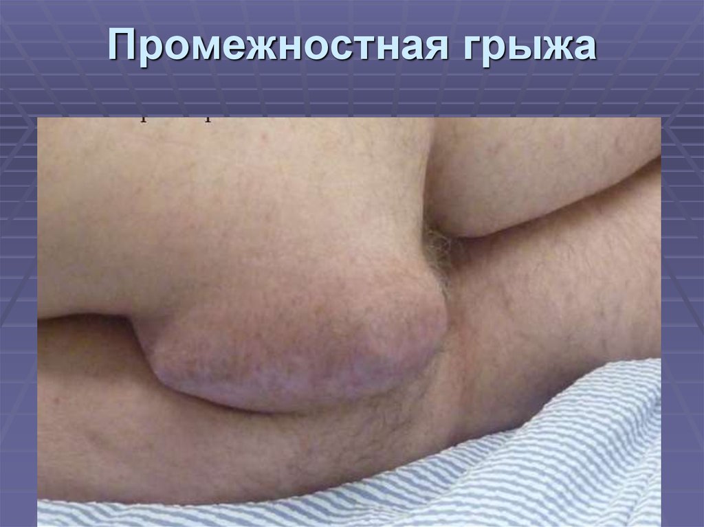 Промежностная грыжа