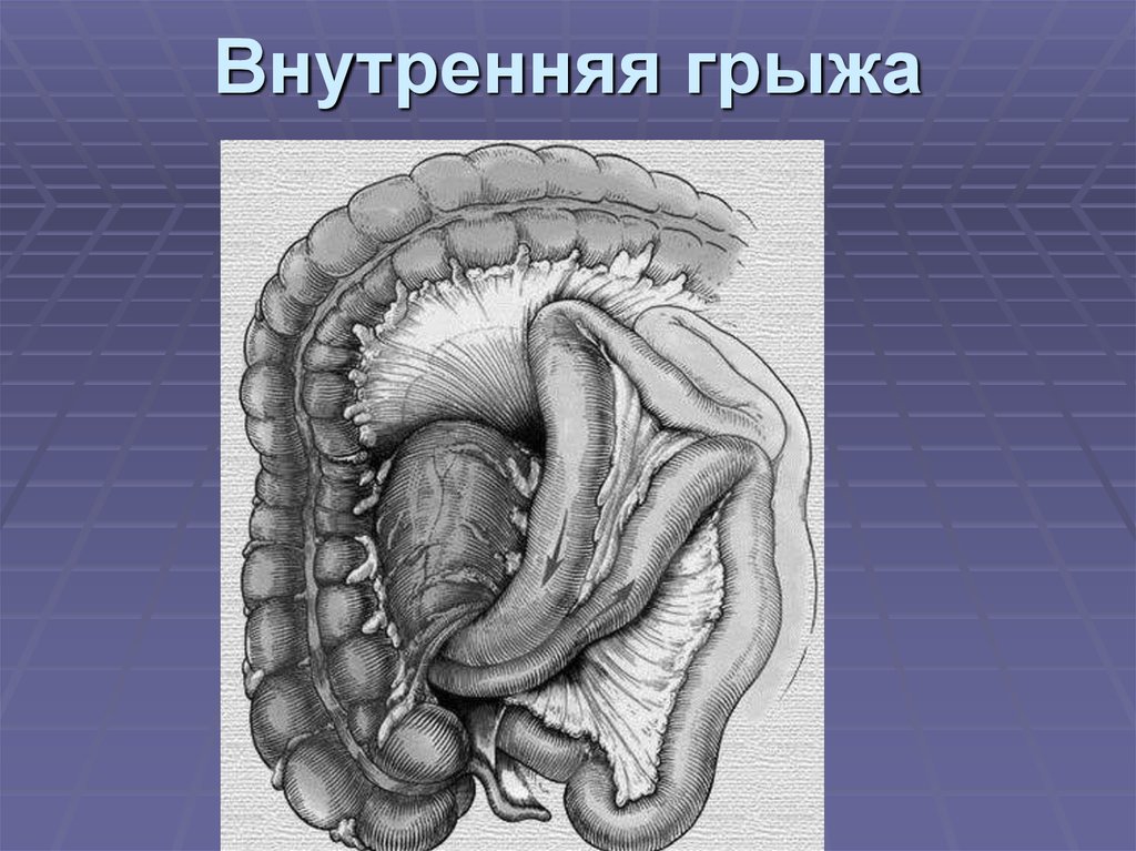 Внутренняя грыжа