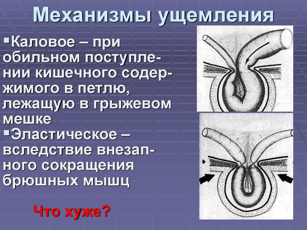 Механизмы ущемления