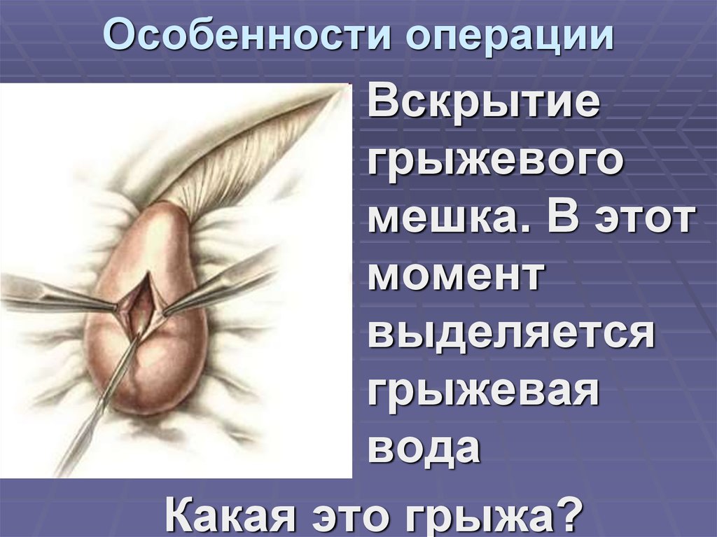 Особенности операции