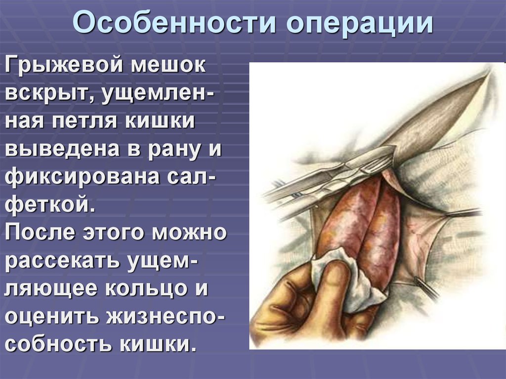 Особенности операции