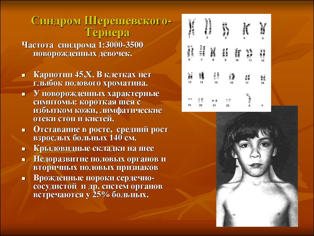 Синдромы человека. Шерешевский Тернер кариотип. Синдром Тернера кариотип 45 х. Синдром Шерешевского Тернера кариотип. Кариотип человека при синдроме Шерешевского Тернера.