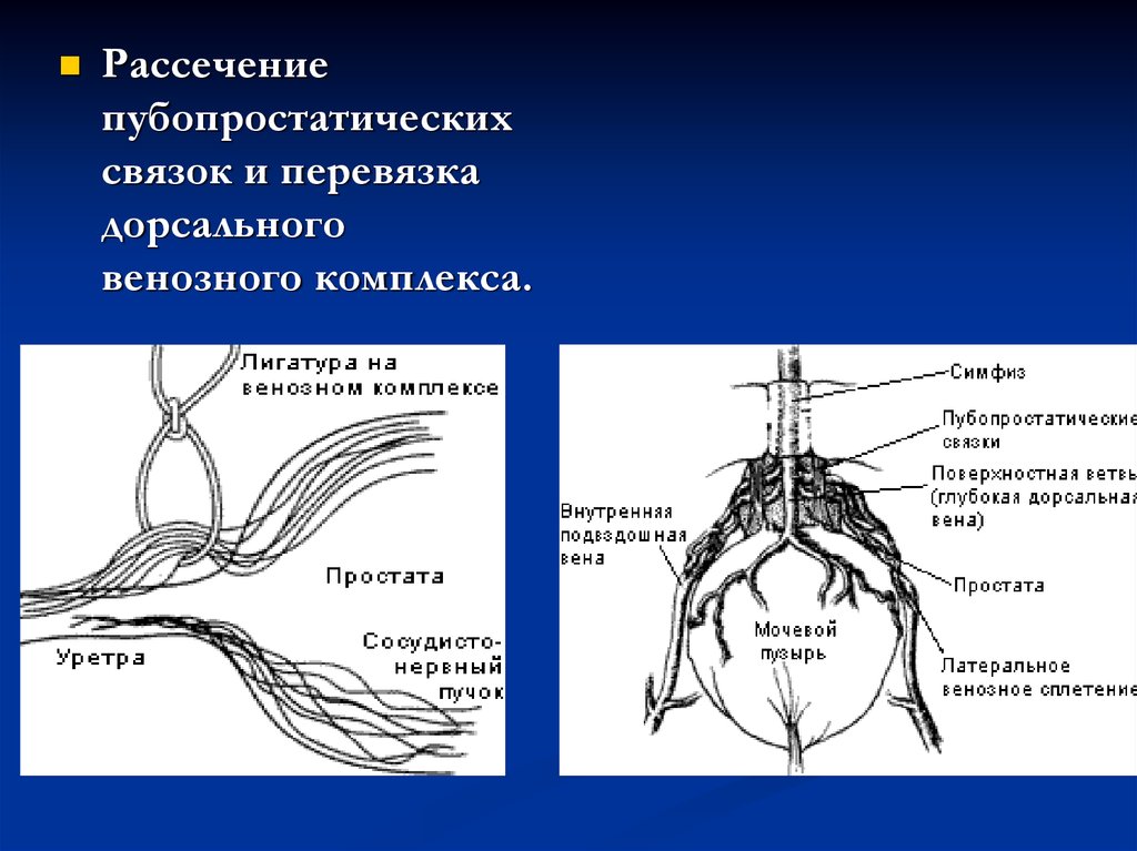 Дорсальная вена. Дорсальный венозный комплекс. Кровоснабжение простаты. Дорсальный венозный комплекс предстательной железы. Глубокая дорсальная Вена анатомия.