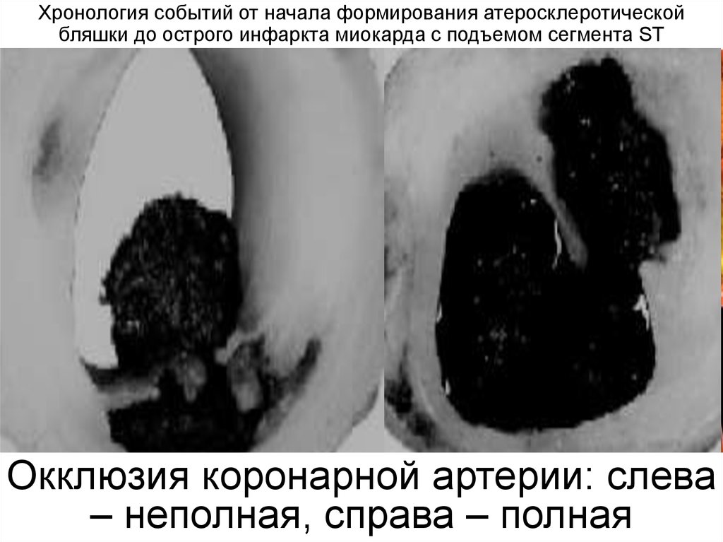 Окклюзия коронарной артерии: слева – неполная, справа – полная