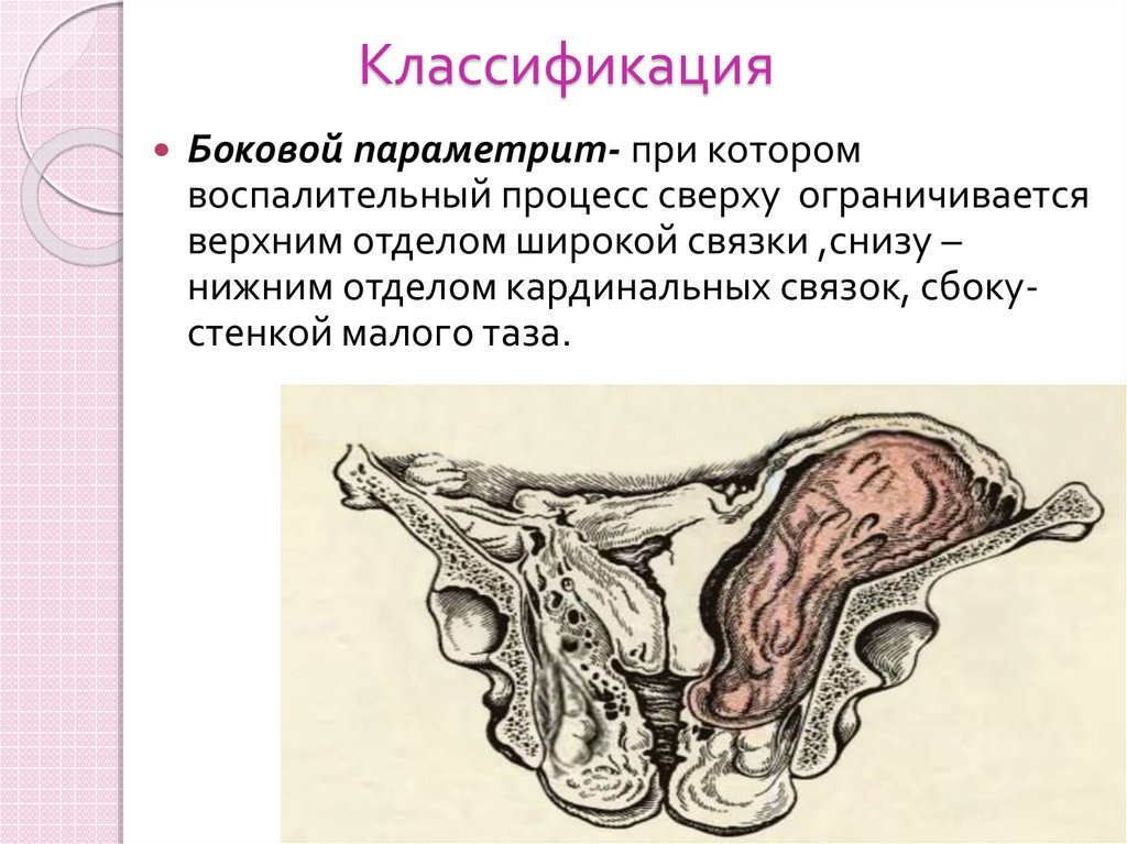 Послеродовый параметрит презентация