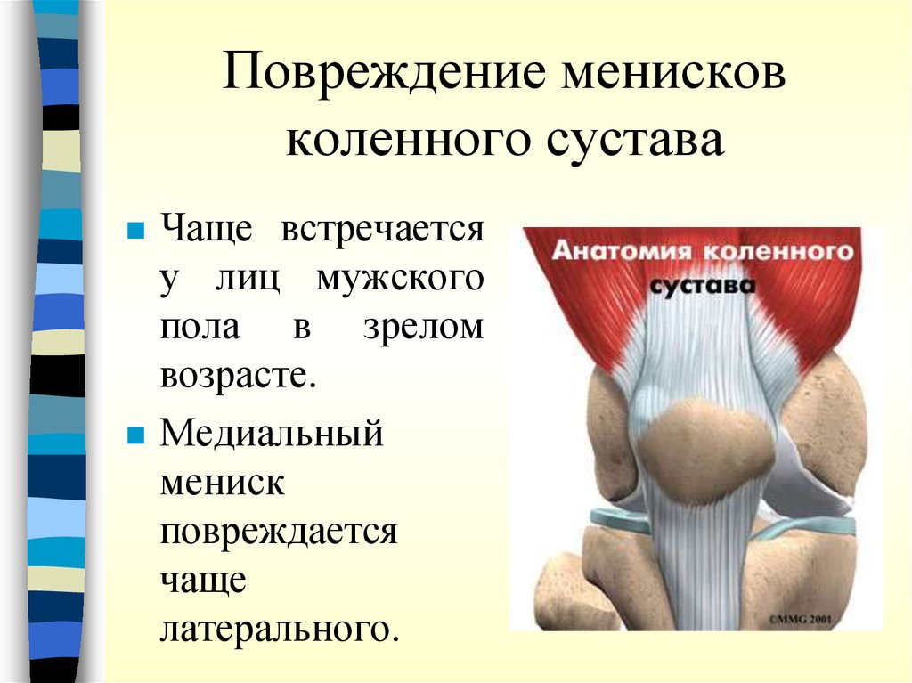 Симптомы мениска. Повреждение мениска коленного сустава. Травма мениска коленного сустава. Ушиб мениска коленного сустава. Повреждение менисков коленного сустава.