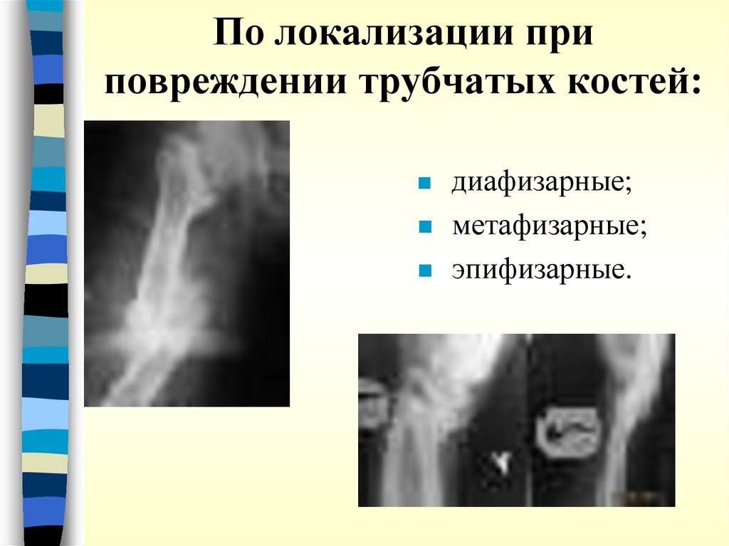 По локализации при повреждении трубчатых костей: