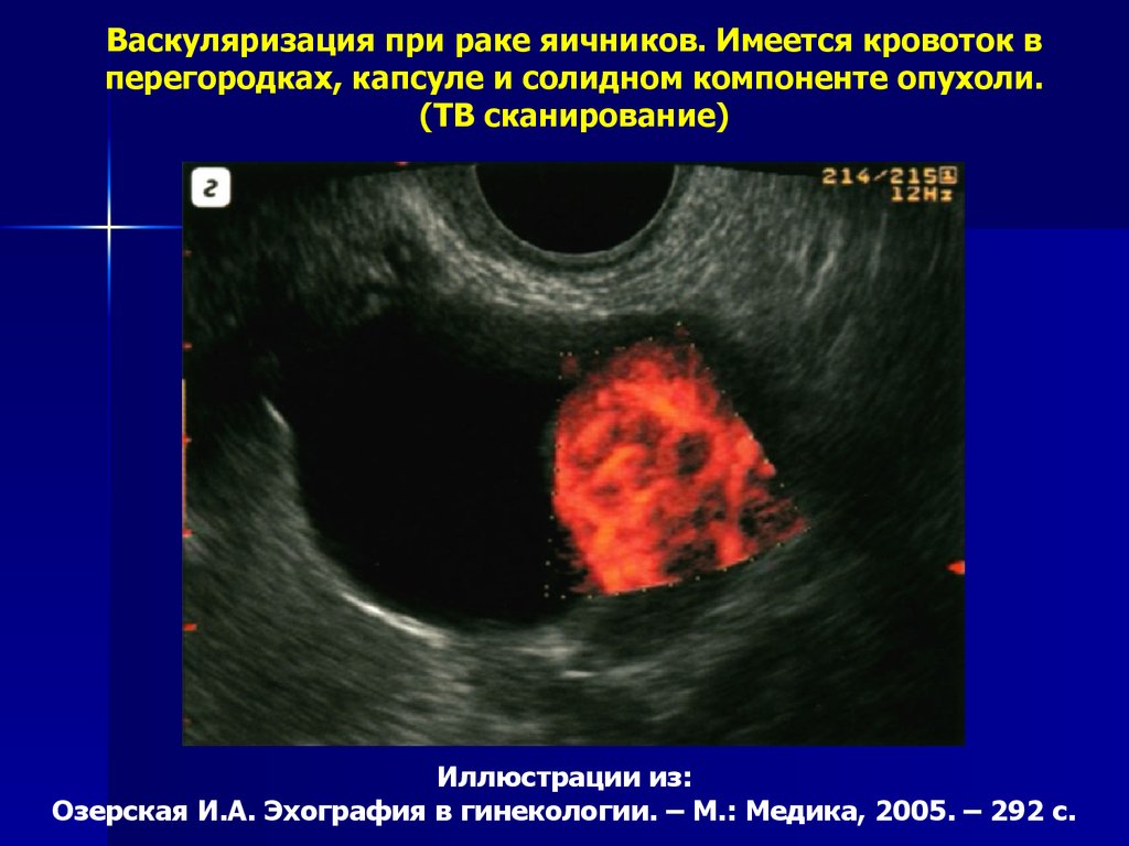 Задержка после кисты. Доброкачественные опухоли яичников. Васкуляризация опухоли.