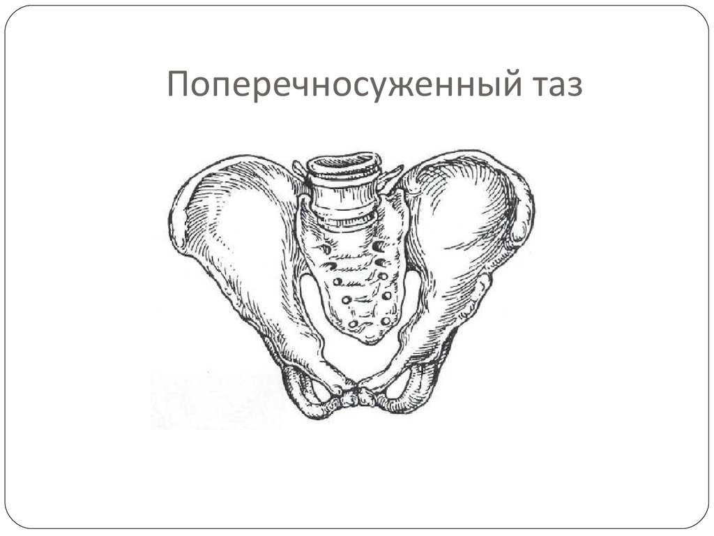 Узкий таз у женщин фото