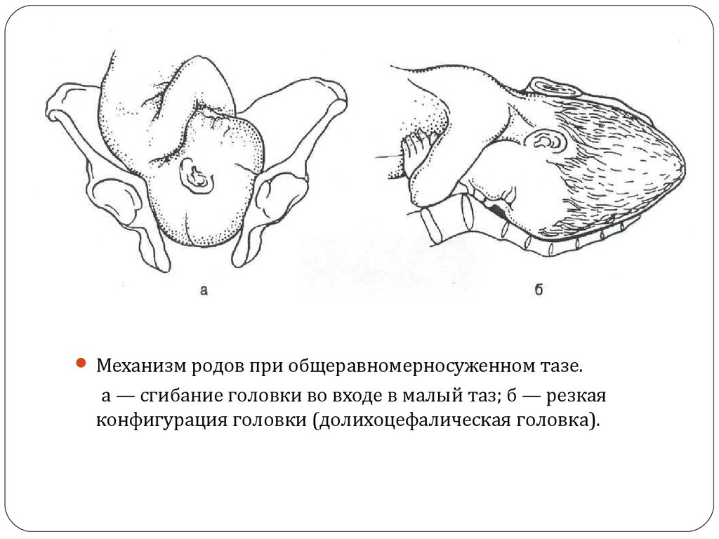 Роды тазом. Общеравномерносуженный таз биомеханизм родов. Механизм родов при общеравномерносуженном тазе. Общеравномерносуженный таз особенности биомеханизма родов. Биомеханизм родов при равномерно суженном тазе.