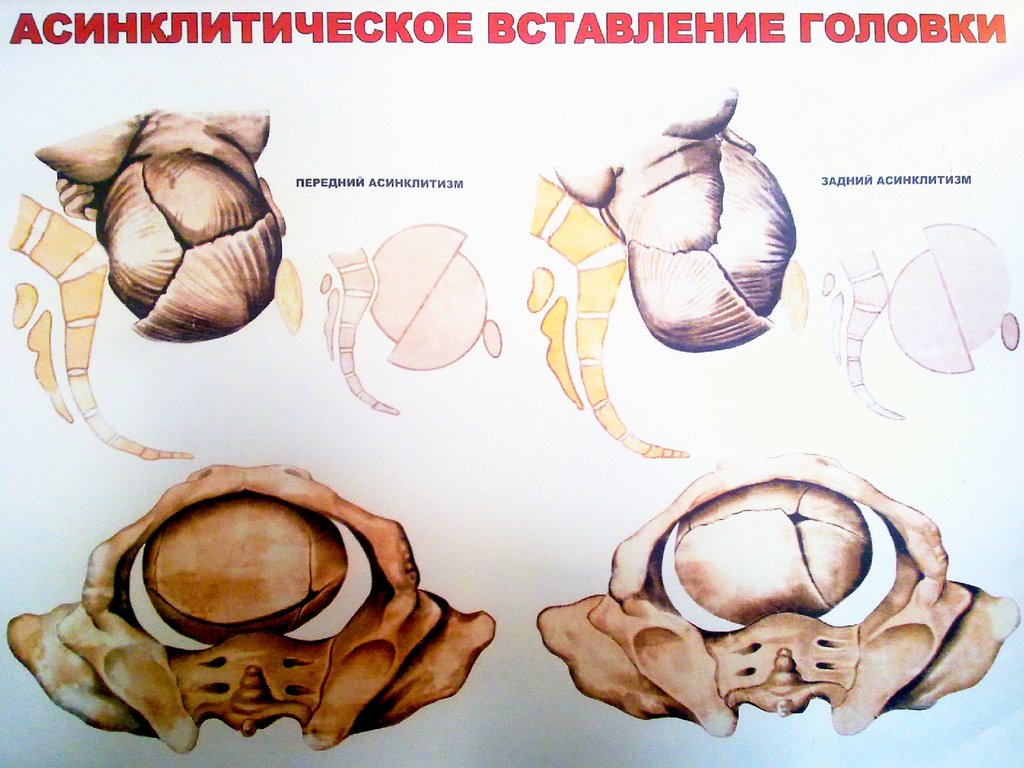 Вставление головки виды