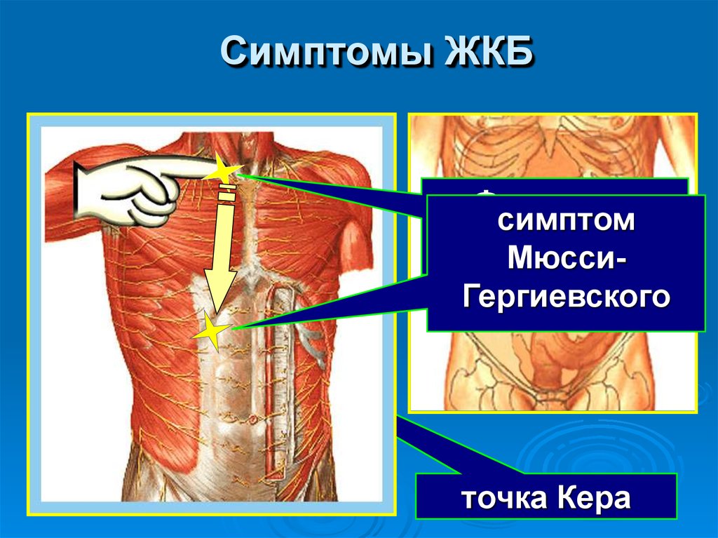 Симптом кера мюсси