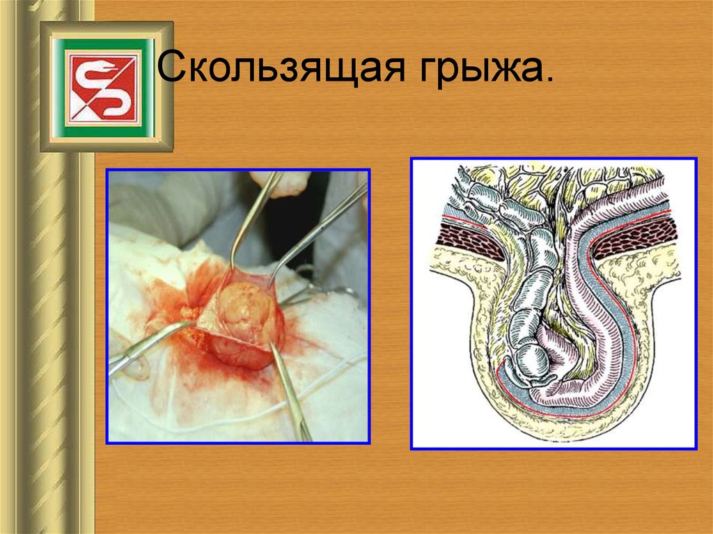 Грыжа брюшной стенки фото