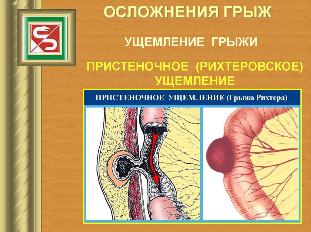 Грыжа брюшной стенки фото