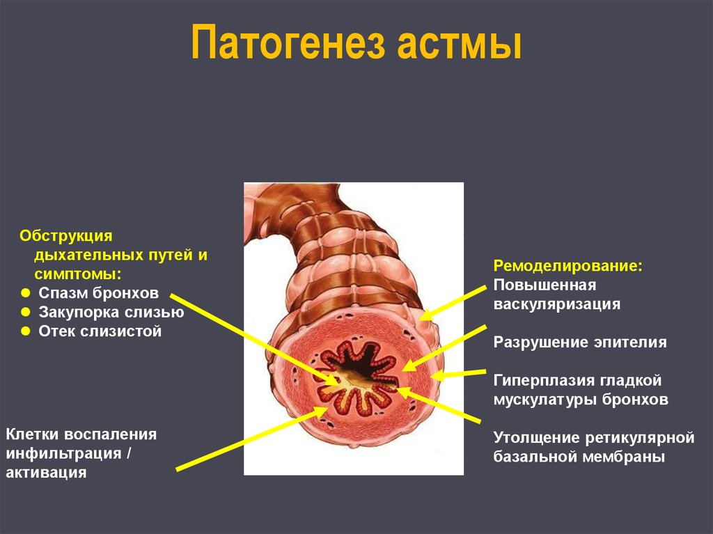 Бронхиальная обструкция. Спазм гладкой мускулатуры бронхов. Патогенез обструкции дыхательных путей.