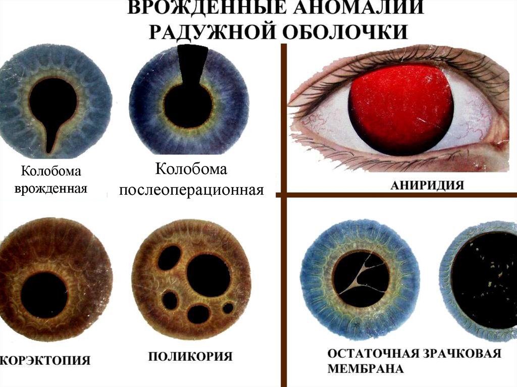 Болезни радужки. Врожденные аномалии сосудистой оболочки глаза. Гипоплазия радужной оболочки. Аномалии развития сосудистой оболочки.