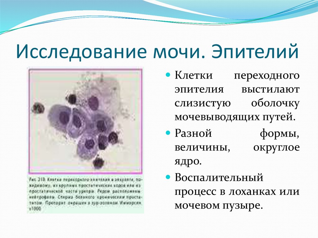 Повышенный эпителий в моче у мужчин. Эпителиальные клетки плоские в моче. Кубический эпителий в моче. Цитологическое исследование на атипичные клетки. Исследование мочи на атипичные клетки.