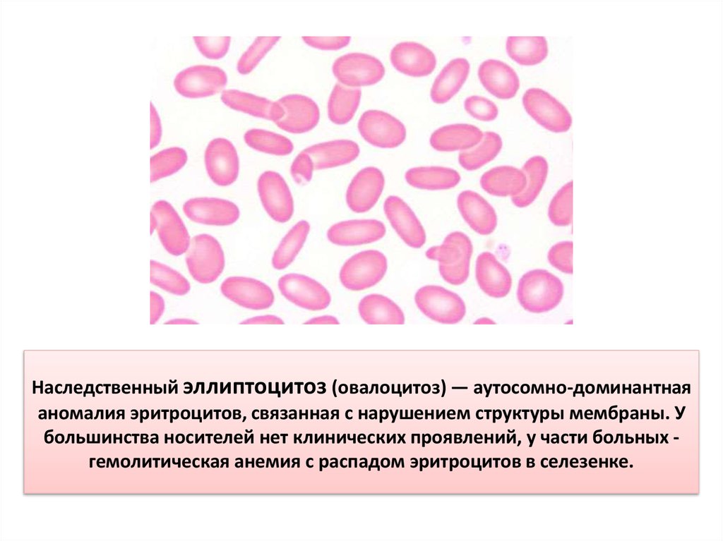 Эллиптоцитоз. Гемолитическая анемия овалоцитоз. Врожденный эллиптоцитоз. Овалоцитоз эритроцитов. Наследственный овалоцитоз.