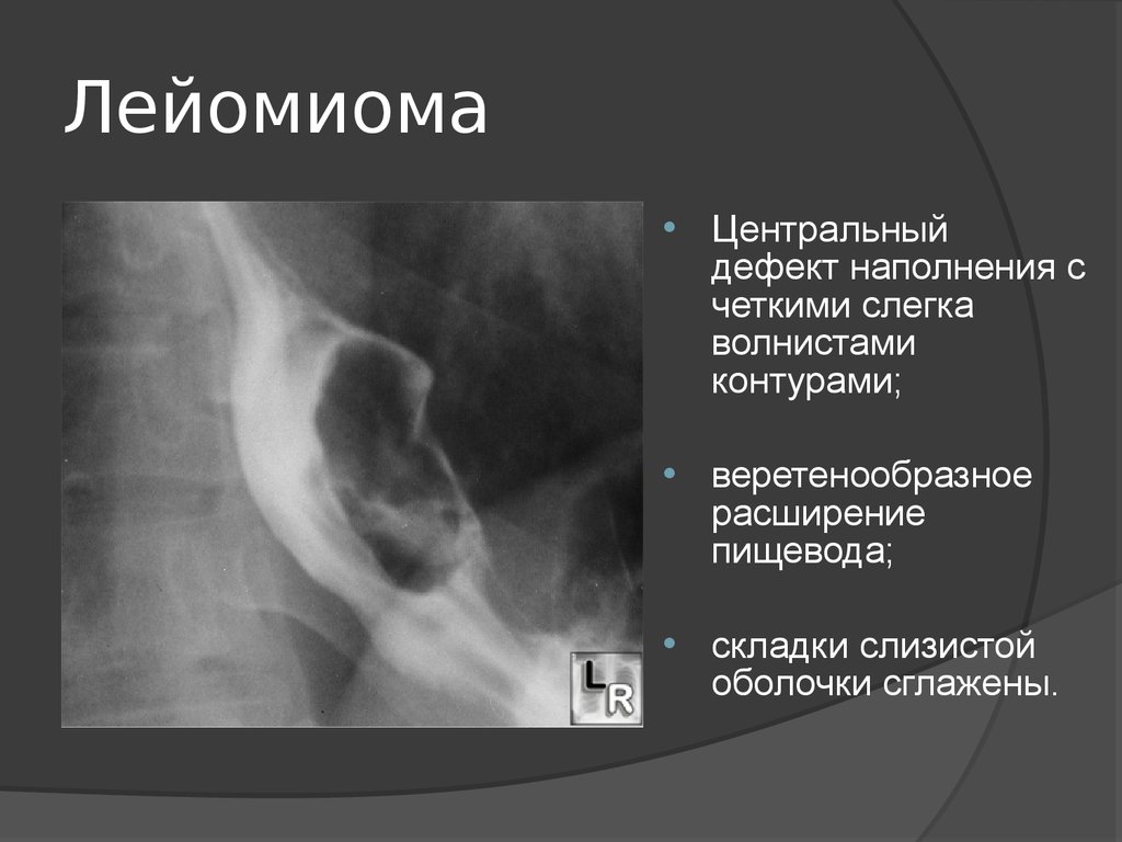 Симптомы рака пищевода. Лейомиома пищевода рентген. Дефект наполнения пищевода рентген. Доброкачественная опухоль пищевода рентген. Лейомиома желудка рентген.