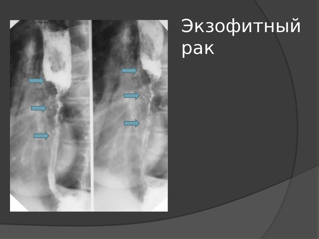 Рентгенологическая картина рака пищевода экзофитный эндофитный