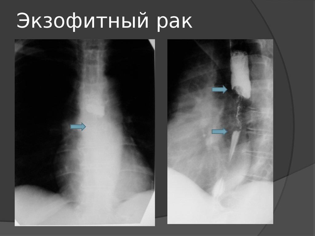 Рентгенологическая картина рака пищевода экзофитный эндофитный