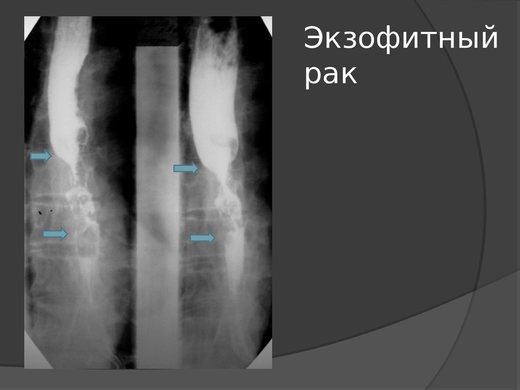 Рак пищевода метастазы