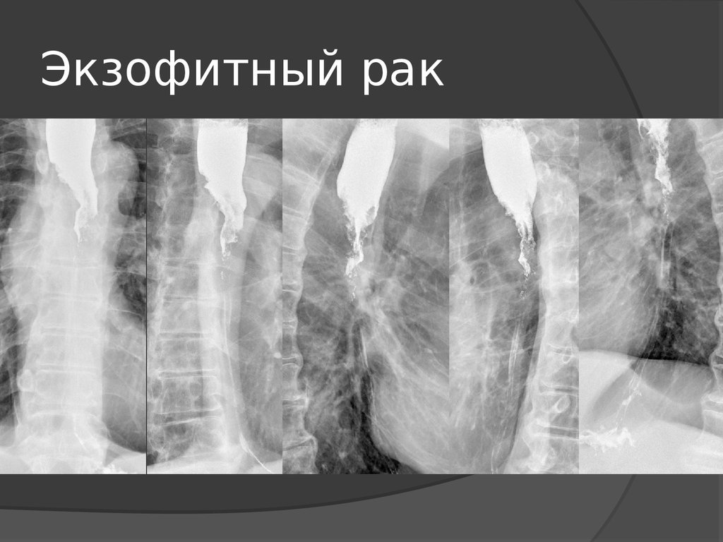 Рентгенологическая картина рака пищевода экзофитный эндофитный