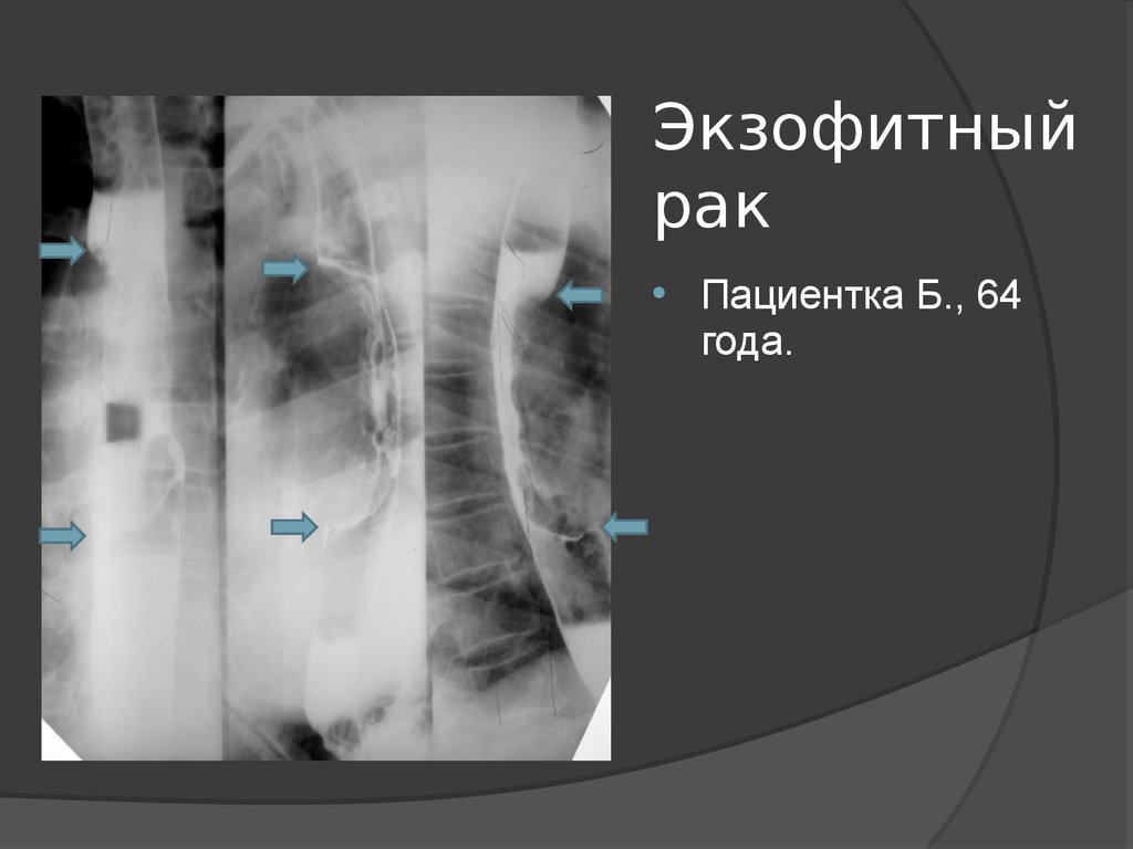 Экзофитный рак. Экзофитный рост опухоли пищевода. Экзофитные опухоли на рентгене. Экзофитное неоплазма пищевода. Экзофитное образование.