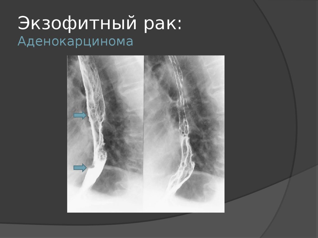 Рентгенологическая картина рака пищевода экзофитный эндофитный