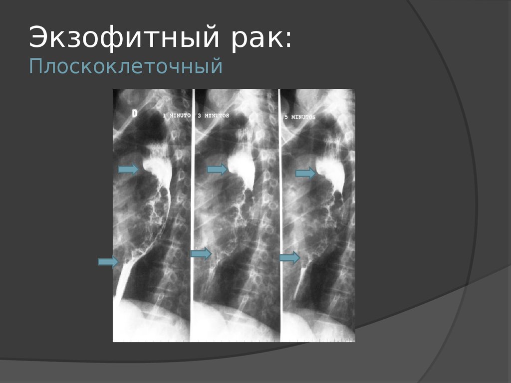 Рентгенологическая картина рака пищевода экзофитный эндофитный