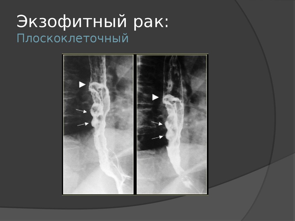 Рентгенологическая картина рака пищевода экзофитный эндофитный