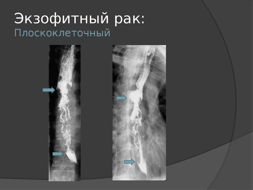 Рак пищевода прогноз