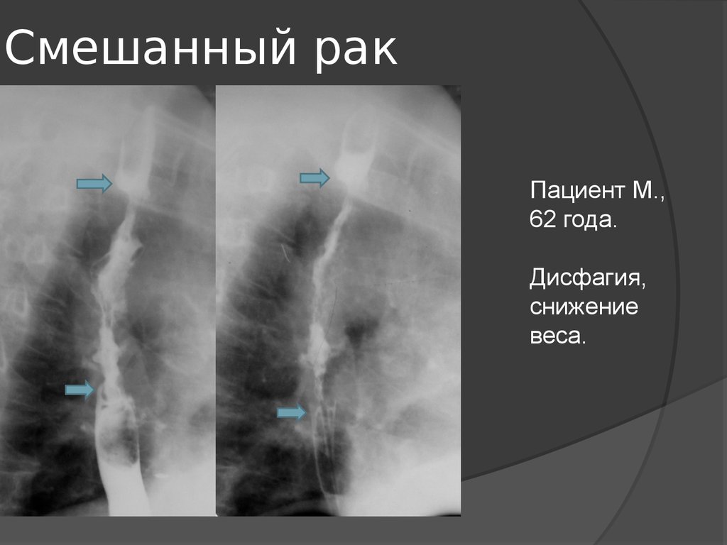 Рентгенологическая картина рака пищевода экзофитный эндофитный