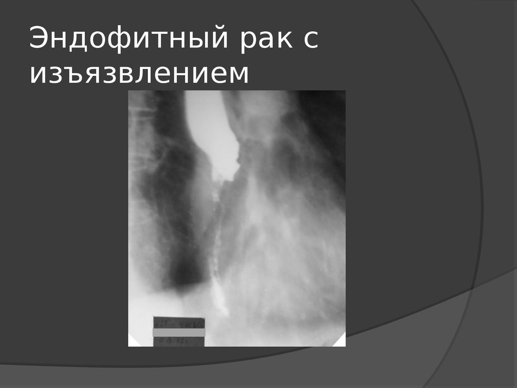 Рентгенологическая картина рака пищевода экзофитный эндофитный