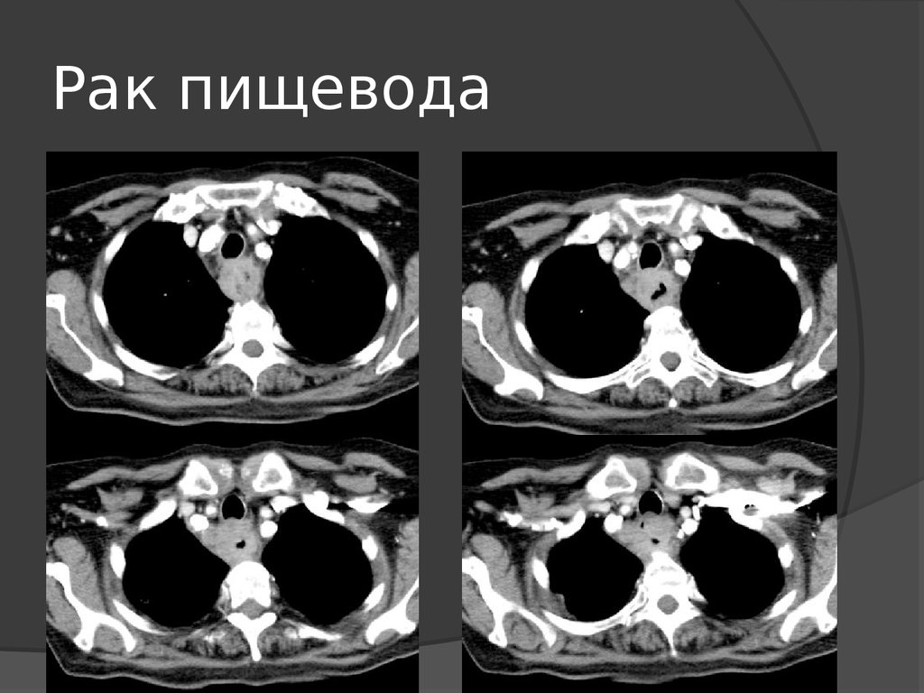 Кт пищевода и желудка