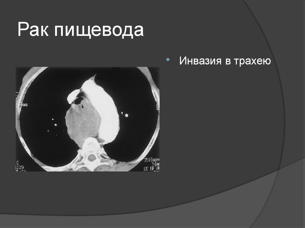 Тест рак трахеи по утвержденным клиническим рекомендациям. Образование пищевода на кт.