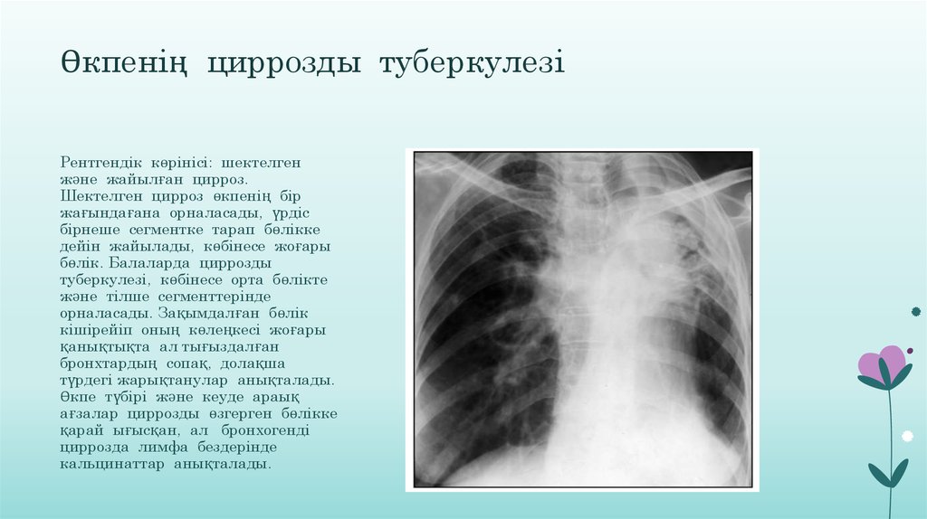Презентация про туберкулез