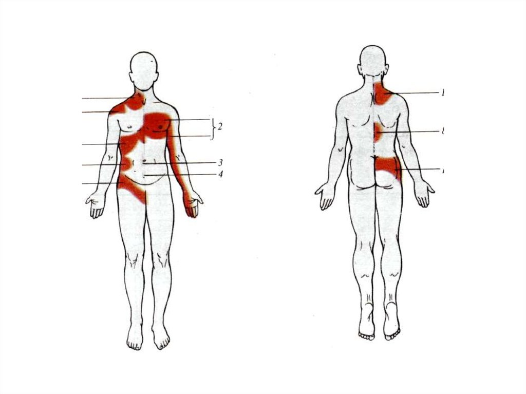 Схема боли в спине. Локализация боли в теле. Локализация боли в спине. Локализация боли на теле человека.