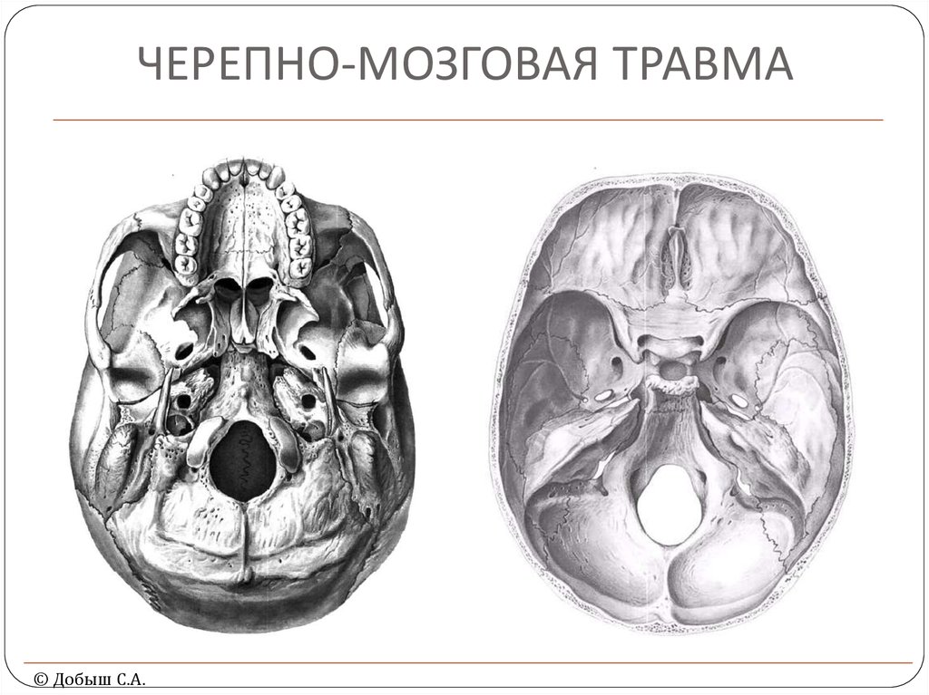 Закрытая черепно мозг травма. Черепно-мозговая травма. Черепная мозговая травма. Черепно-мозговая черепно-мозговая травма.