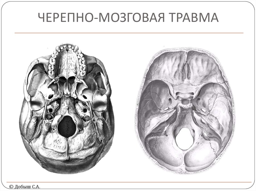 Черепно мозговая. Черепно-мозговая травма. Черепная мозговая травма.