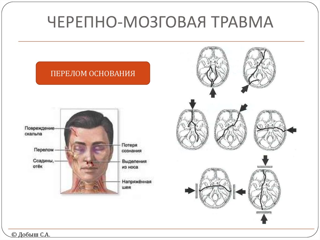 Закрытая мозговая травма. Черепномозговя травма. Черпная Мозгово травма. Сеоепно мозгоапя Травиа. Черепа-могговая травма.