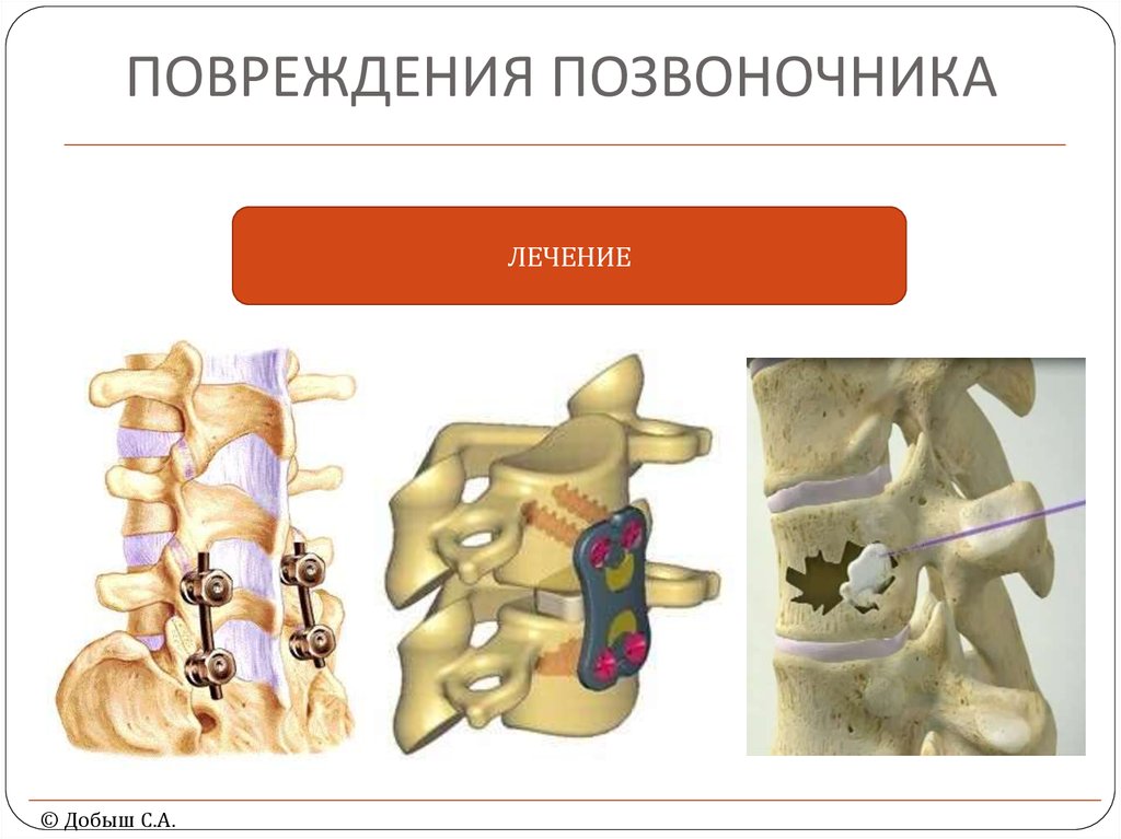 Повреждение позвоночника. Повреждения позвоночника лекарства. Травма позвоночника, спины.