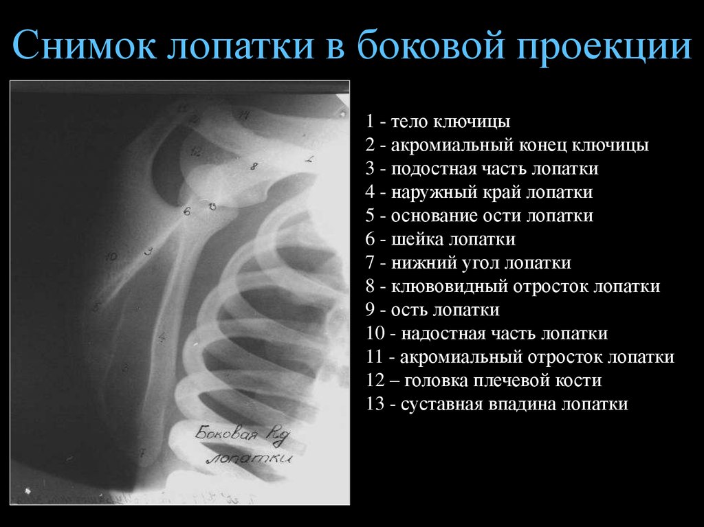 Ключица укладка. Анатомия лопатки рентген. Рентгенанатомия плечевого сустава норма. Рентген лопатки в боковой проекции. Рентгенография лопатки в боковой проекции укладка.