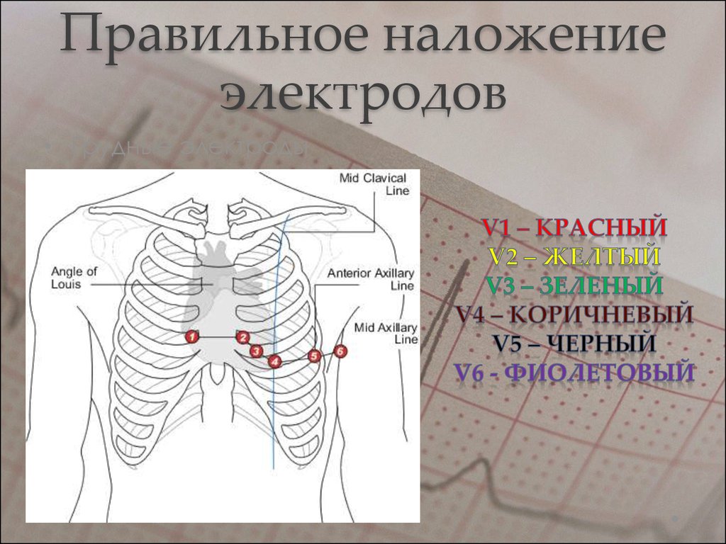 Как снять экг схема наложения электродов и присосок схема