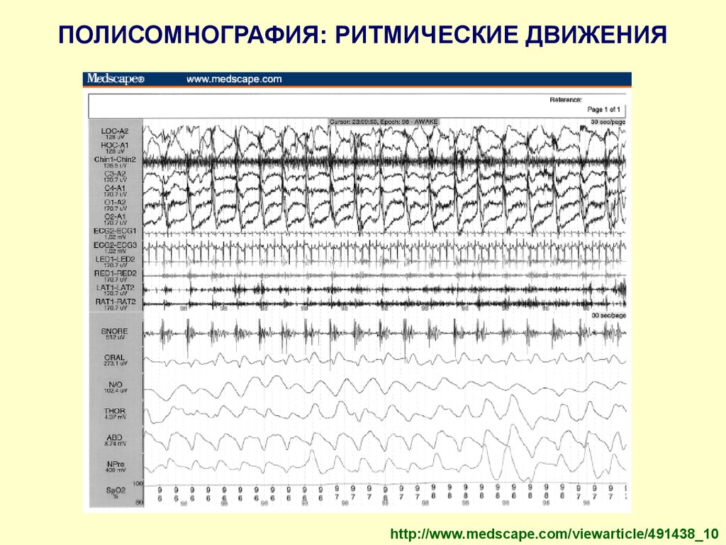 Полисомнография. Полисомнография показатели. Полисомнография графики. Полисомнография Результаты. Полисомнография заключение.