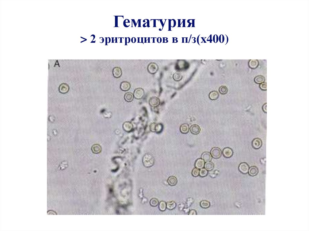 Измененные эритроциты в моче фото