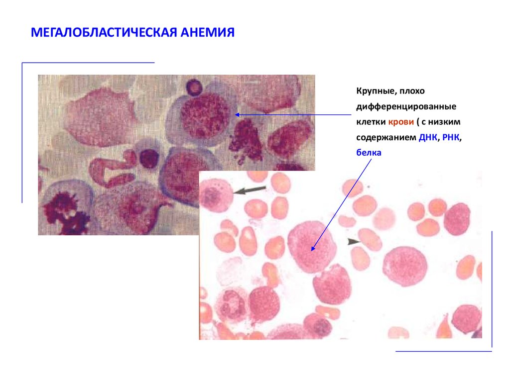 Мегалобластная анемия клиническая картина